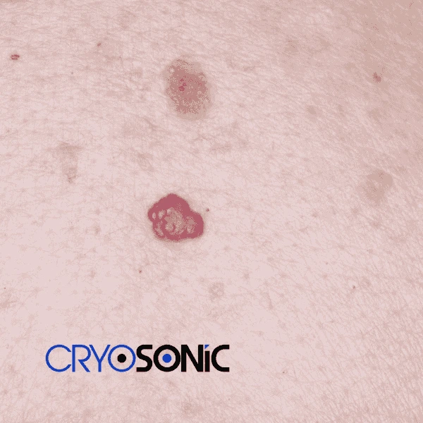 Looking for pain free cherry angioma removal treatment Aylesbury? Call our team today! Aylesbury
