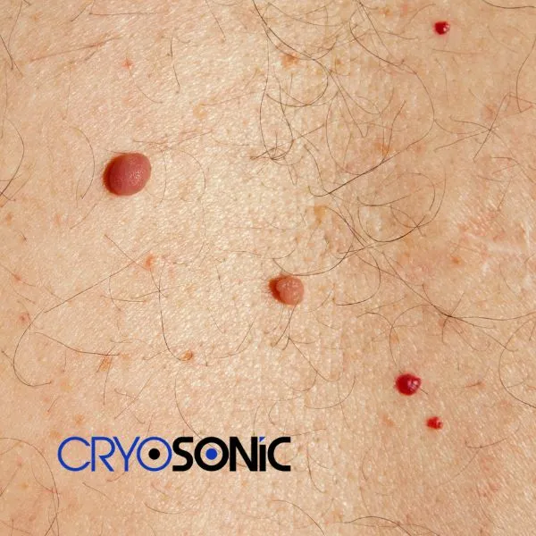get cherry angioma removal treatment today! Aylesbury