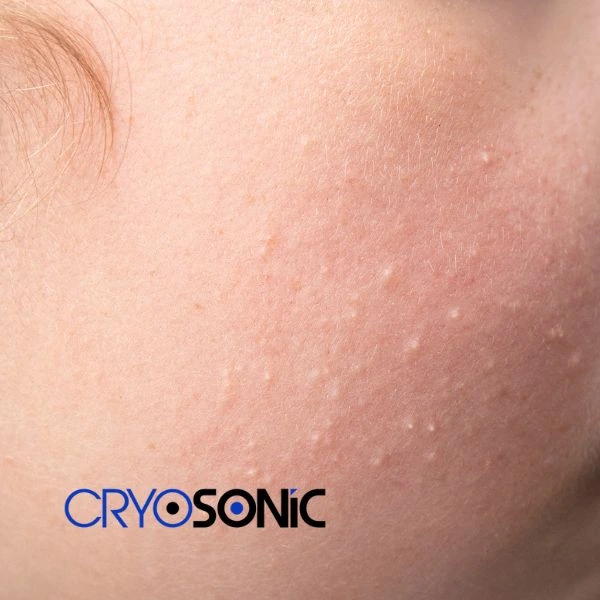 Are you looking for milia removal treatment? Contact our team today Aylesbury