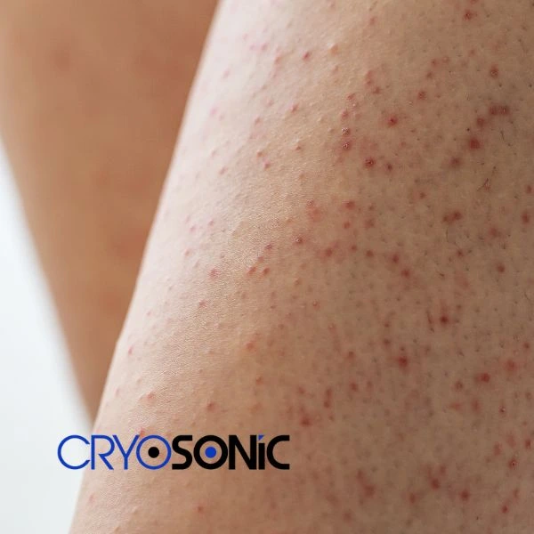 Looking for Seborrhoeic Keratosis removal Aylesbury treatment? Call our consultants today in Aylesbury