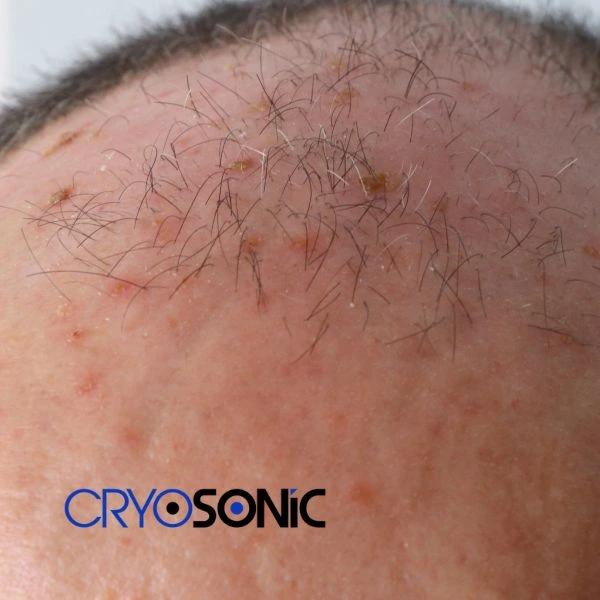 Access Seborrhoeic Keratosis removal from the comfort of your own home! Call us today in Aylesbury