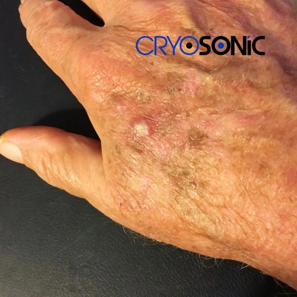 Understand more about actinic keratosis treatment today Aylesbury