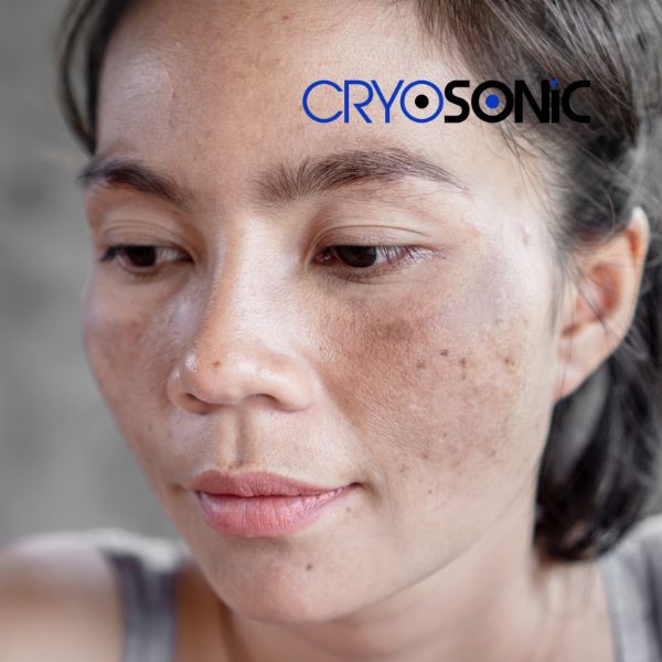 Ready to start age spots removal? Contact our team today in Aylesbury