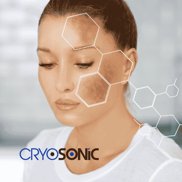 Are you looking for age spot removal treatment? Contact Cryosonic today in Aylesbury