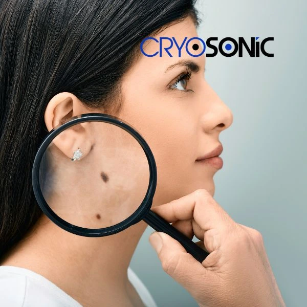 Do you want to learn more about benign moles removal treatment? Call our team today Aylesbury