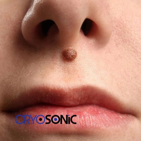 Start your benign moles removal treatment today Aylesbury