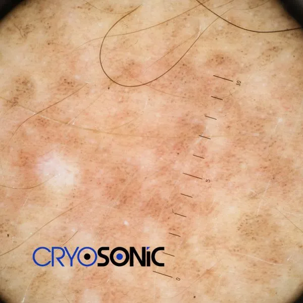 Speak to our team today about sun damaged skin treatment today in Aylesbury