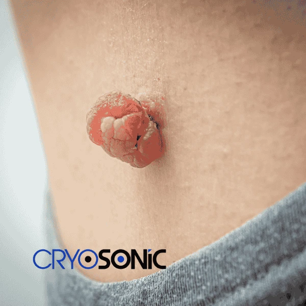 Book your skin tags removal Aylesbury from comfort of your own home! Aylesbury