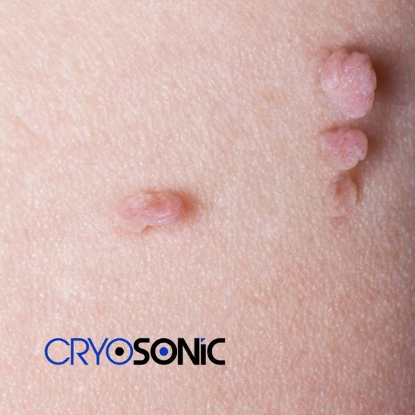 Are you looking for fast effect skin tag removal Aylesbury? Book in NOW! Aylesbury
