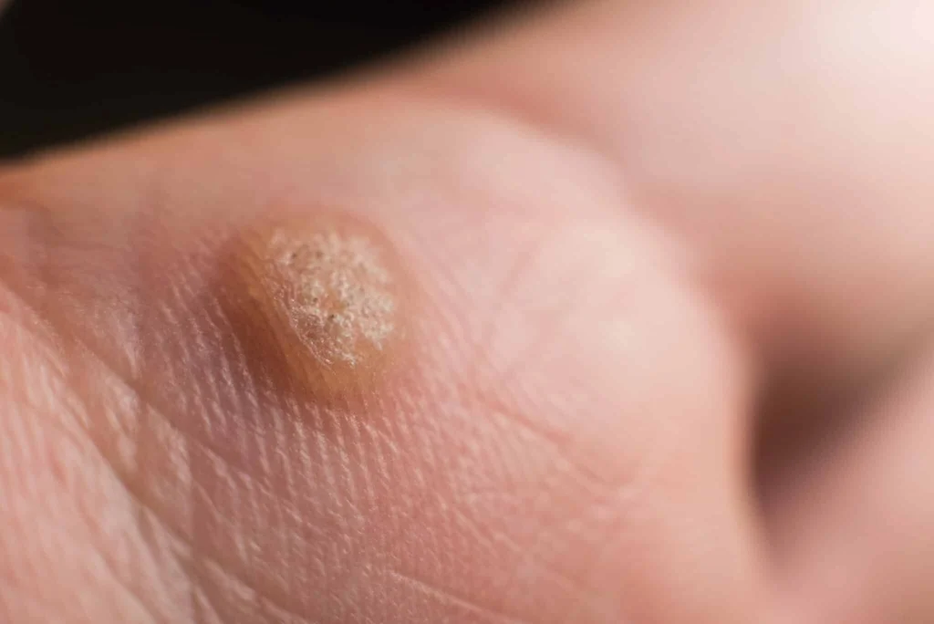CryoPen treatment for Common Warts showing precise freezing of viral skin lesions for safe and effective removal Aylesbury