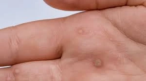 CryoPen treatment results showing smooth skin after Common Warts Aylesbury removal with reduced risk of recurrence Aylesbury