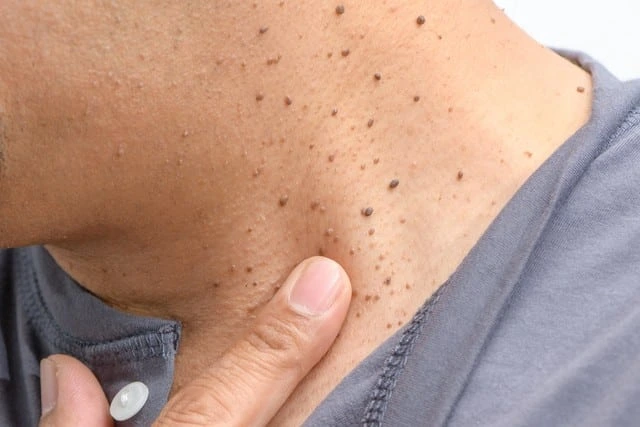 Benefits of Cryosonic CryoPen Aylesbury for darker skin, highlighting safe, fast, and precise removal of Dermatosis Papulosa Nigra Aylesbury