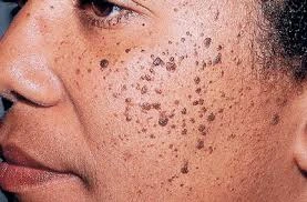 Cryosonic CryoPen treatment Aylesbury showing Dermatosis Papulosa Nigra on darker skin Aylesbury