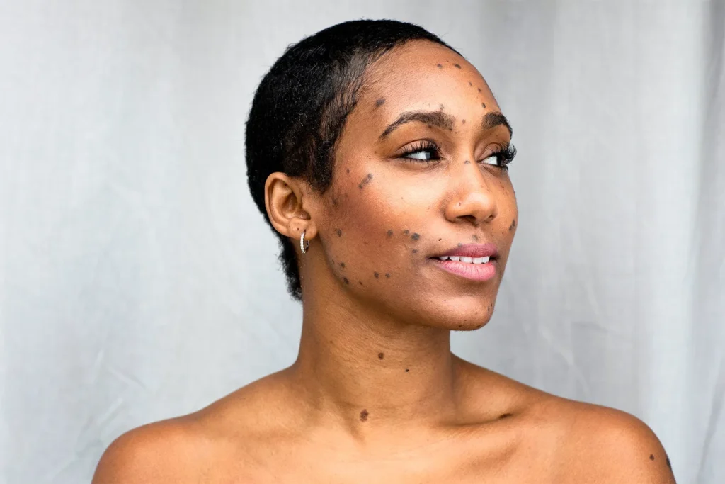 Dermatosis Papulosa Nigra on darker skin treated with Cryosonic CryoPen, showing genetic factors and effective removal Aylesbury