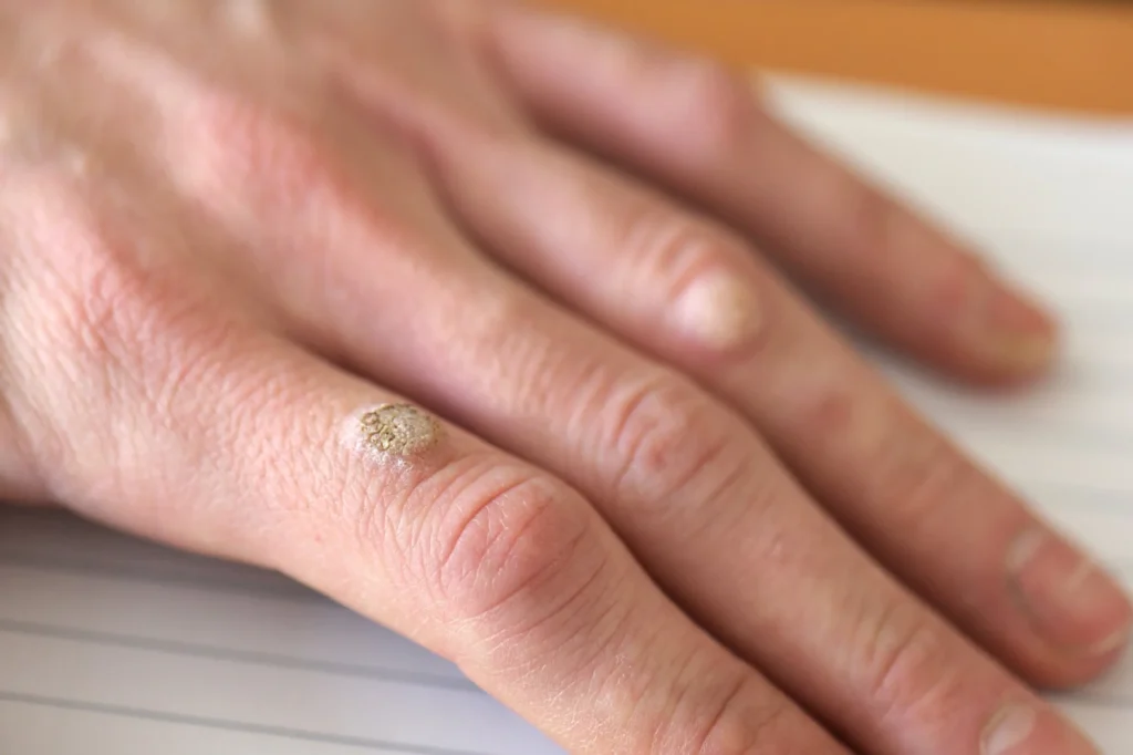 Patient considering removal of Common Warts Aylesbury for cosmetic improvement, comfort, and hygiene with CryoPen treatment Aylesbury