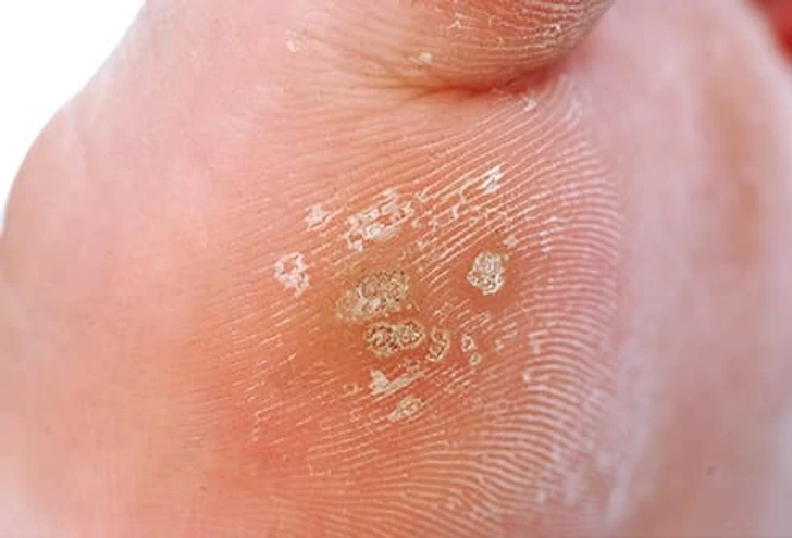 Close-up of Common Warts Aylesbury on skin, showing small rough viral lesions typically caused by HPV infection Aylesbury