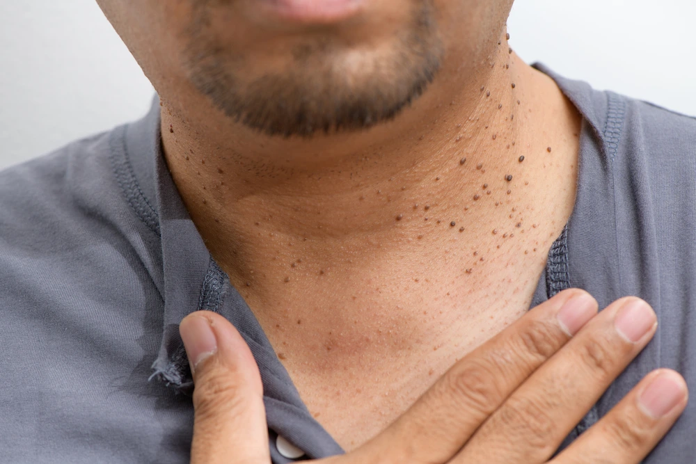 Dermatosis Papulosa Nigra Aylesbury on darker skin, showing genetic factors Aylesbury