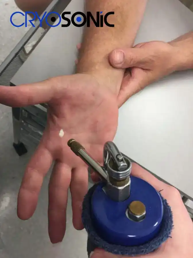 Temperature Differences: OTC vs Medical-Grade Cryotherapy Aylesbury